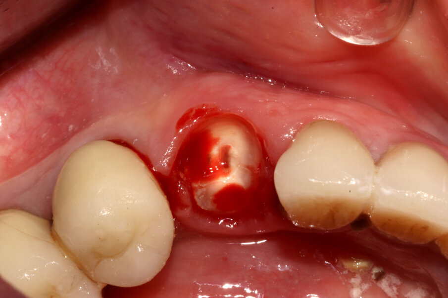 Figg. 5-7_Fasi della Socket-Shield: decoronazione, svuotamento del lume canalare e asportazione della porzione linguale della radice tramite protocollo “Preserving Nature”.