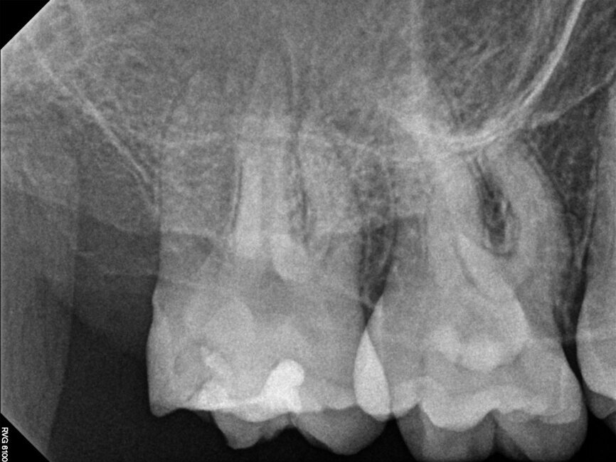 Fig. 13a: Case treated with Chlor-Xtra, SmearOFF with EndoUltra activation. Note the excellent cone fit and apical control of obturation. (Courtesy of Dr. Sam Alborz)