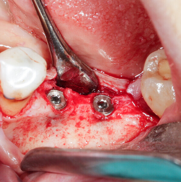 Fig. 5: Low residual bone thickness in the vestibular area of the implants.