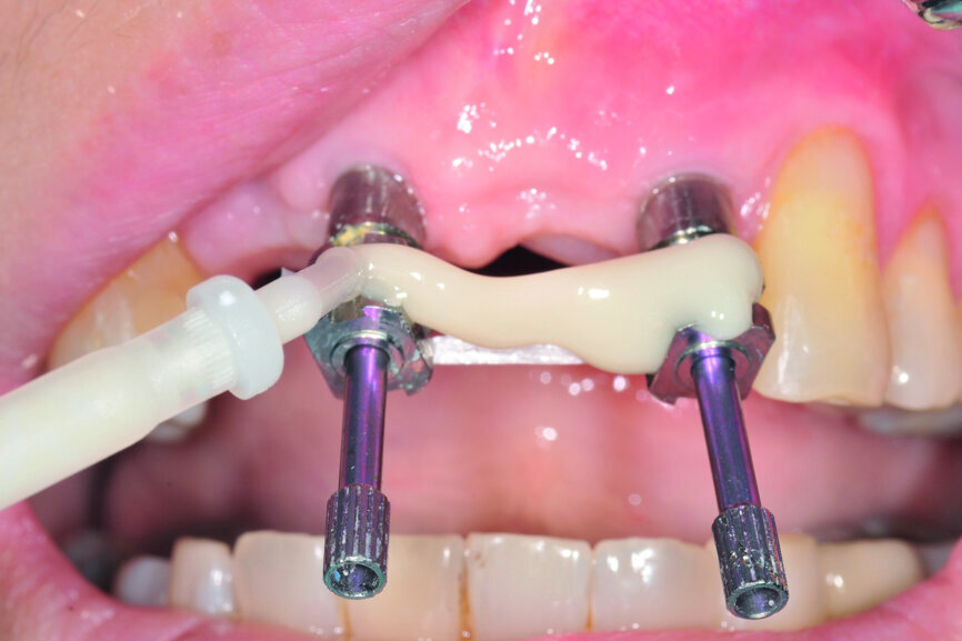 Fig. 12: Two impression copings connected for the implant level impression.