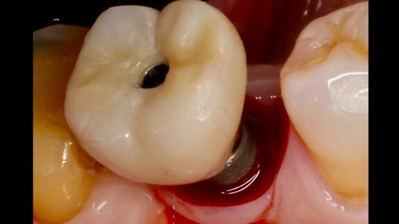 Interacción entre factores protésicos y sistémicos en la periimplantitis 