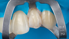Restoring a peg-shaped lateral incisor with universal composite
