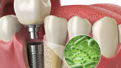 Study lays groundwork for improving success of implants