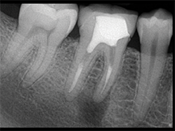 Slika 7: Neuspešan tretman kanala korena sa apikalnom infekcijom i internom resorpcijom u apikalnom delu.