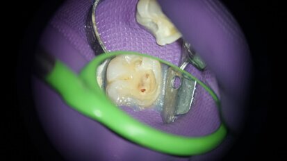 גורמים המשפיעים על ההחלטה לבצע כיפוי מוך ישיר