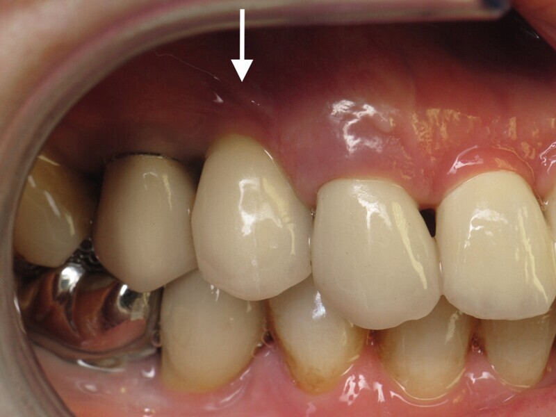 Fig. 10 : Contrôle à un an de 14. 