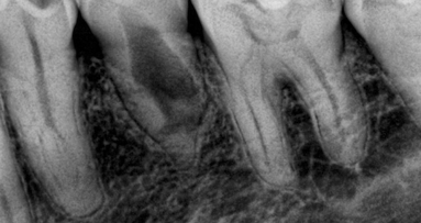 Obturación tridimensional de reabsorción interna
