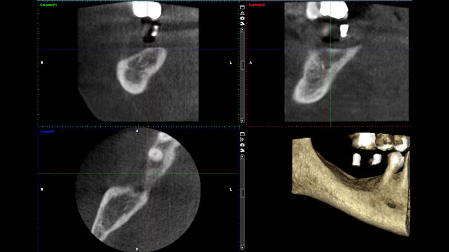 Figg. 1a-1c_Foto clinica e sezioni di CBCT iniziali in cui si evidenzia edentulia distale all’elemento 4.5 con atrofia tridimensionale.