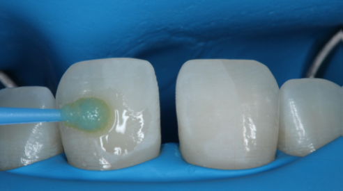 Fig. 7: Application of Prime&Bond universal™