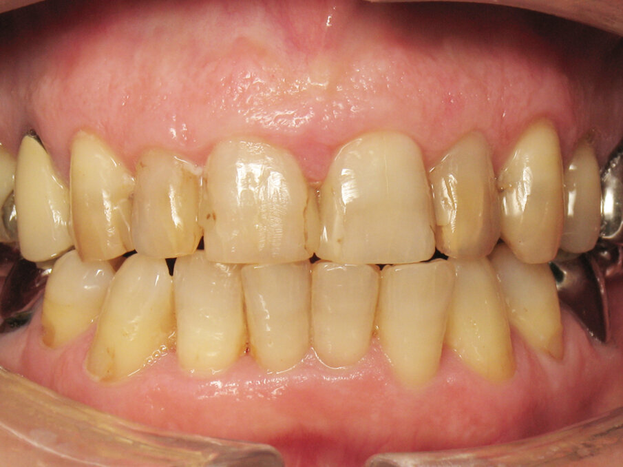 Fig. 2: Initial situation, frontal view with lips retracted. 
