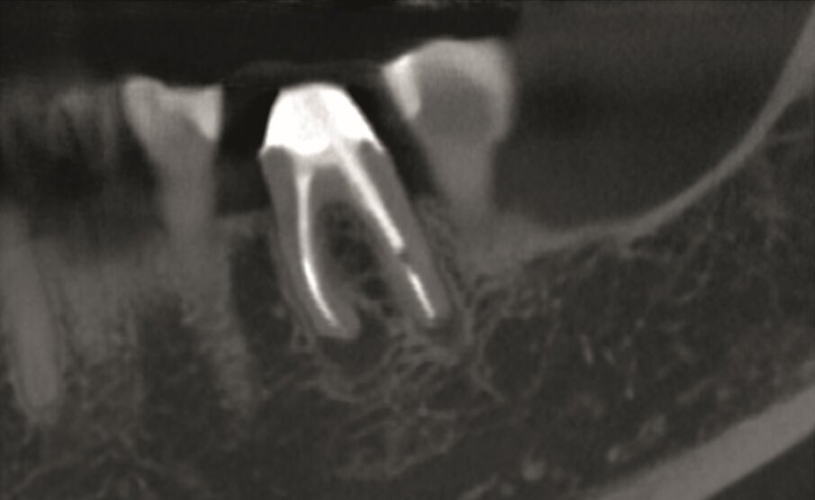 …and sagittal views (c) showed a hypo-dense zone around the apical third of the mesial and distal roots and intact cortical buccal bone.