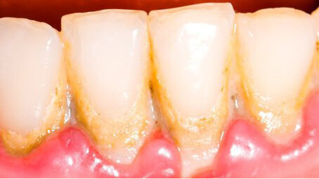 Nový výzkum zjistil významnou souvislost mezi chronickou parodontitidou a cévní mozkovou příhodou