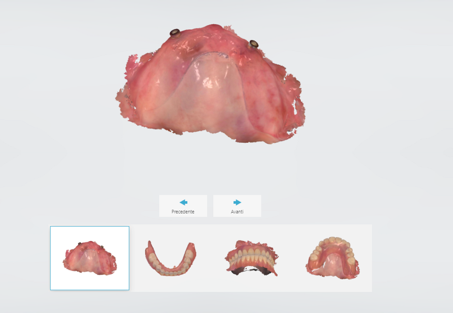 Fig. 5 - Lo scanner intra-orale oggi è uno strumento con grandi potenzialità anche per la scansione dell’edentulia totale.