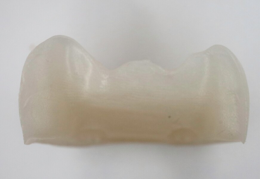 Fig. 16b: Milled zirconia pinlay: lingual view. 