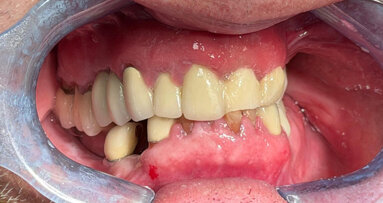 Slide-and-tilt stackable surgical guides for full‑arch implant reconstruction—Part 1: Maxillary arch