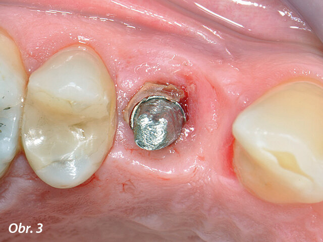 Neodstraněný přebytek cementu v okolí implantátu