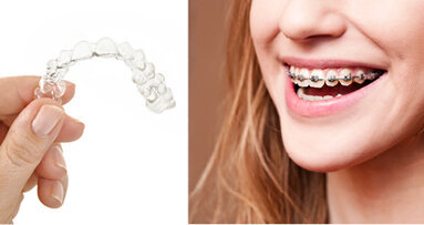 Studie zjistila, že jsou průhledná snímatelná rovnátka prospěšnější než fixní rovnátka