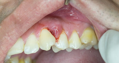 Researchers to develop biodegradable strip and gel to prevent bone loss in periodontitis