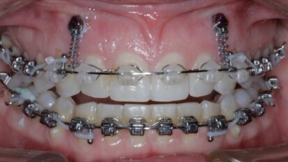 New Age orthodontics and orthopaedics with temporary anchorage devices New Age orthodontics and orthopaedics with temporary anchorage devices