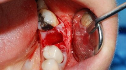 Utilizzo di osso bovino decellularizzato e delipidato e di una membrana in pericardio