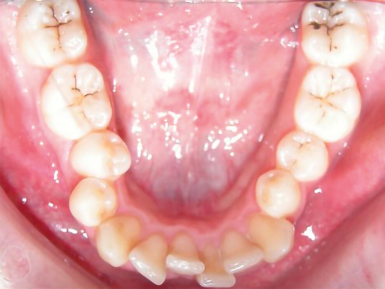 Fig. 1c : Photographie intraorale initiale.