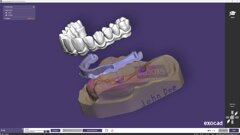 Exocad launches PartialCAD 3.3 Chemnitz with split denture workflow