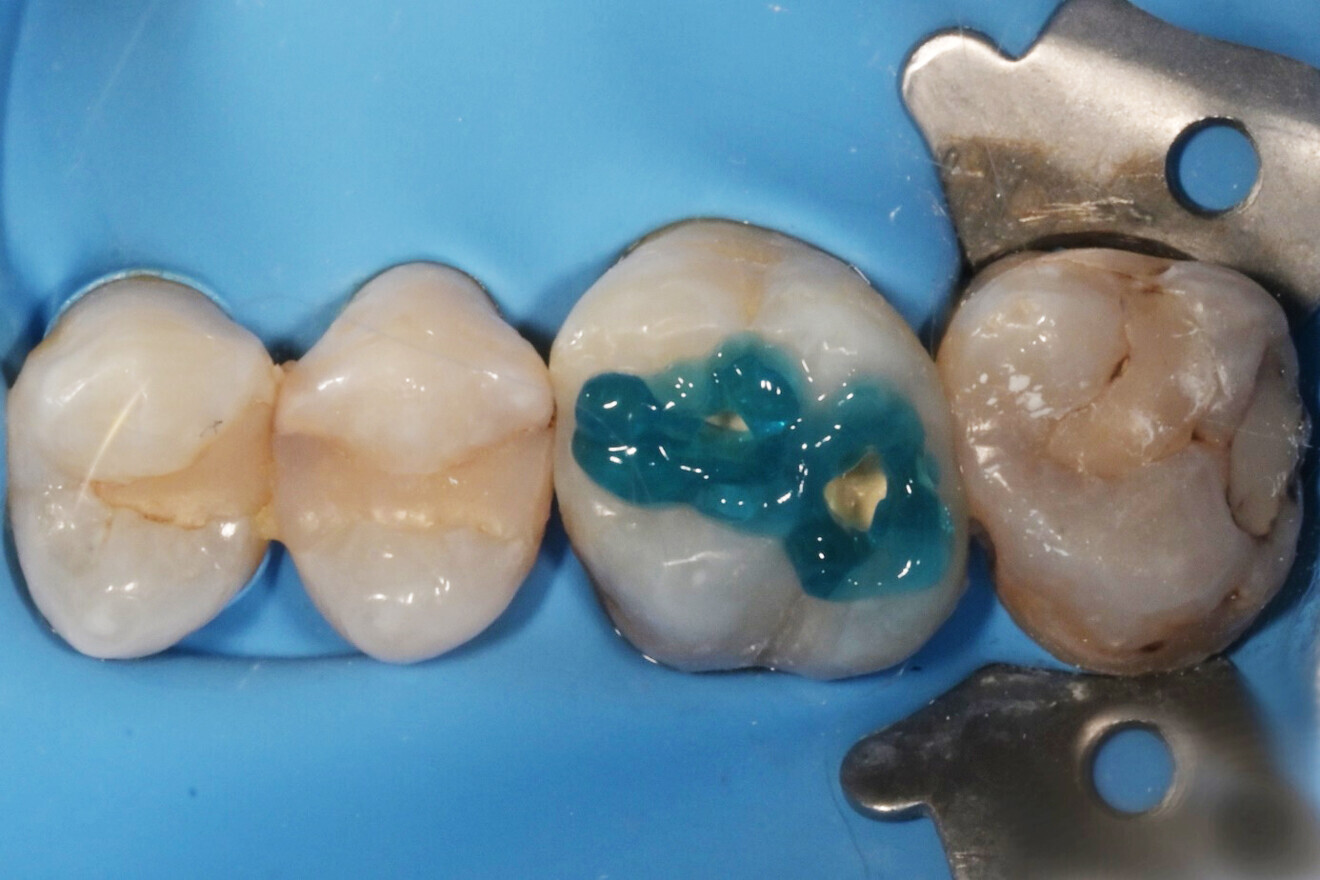 Фиг. 8: Селективно ецване на емайла.