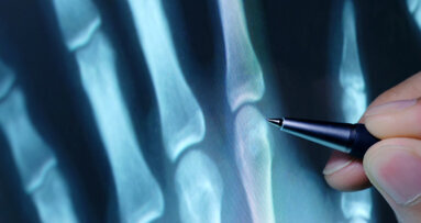 Healthy teeth lower rheumatoid arthritis pain