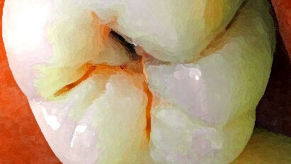 Znanstvenici otkrili molekulu protiv karijesa