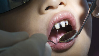 Caries in children: English dentists extract 160 teeth a day