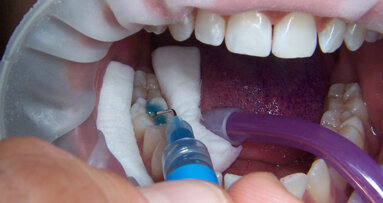 La videocamera intraorale, un valido supporto nella pratica clinica