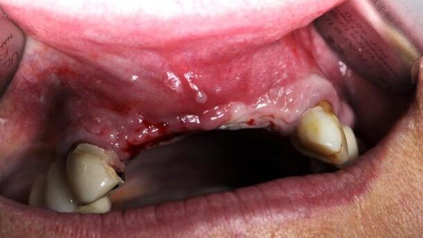 Modyfikowanie dziąsła w strefie estetycznej łącznikami standardowymi i Encode – porównanie metod leczenia