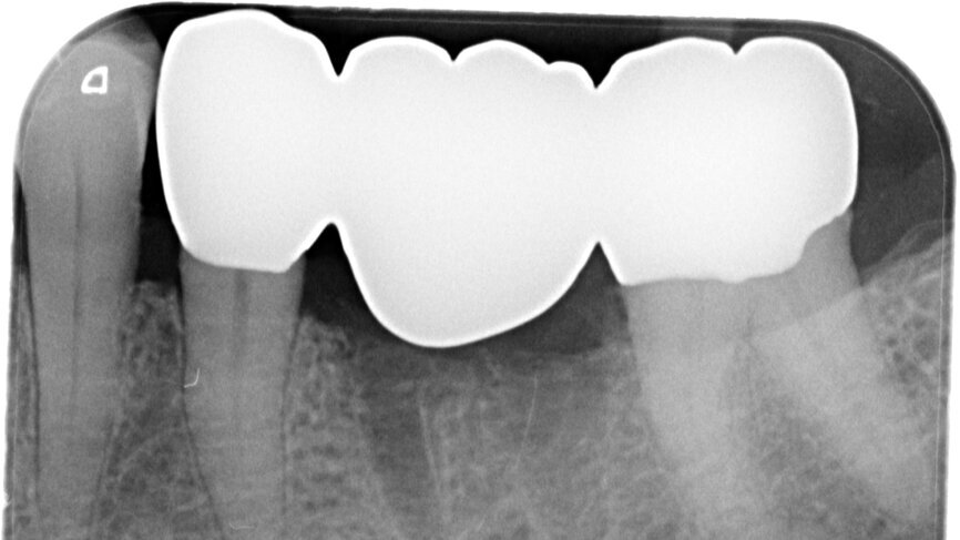 Fig. 13: Final radiograph used to check for excess cement around the bridge.