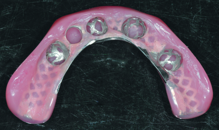 Fig. 11: Completed laboratory restoration showing the metal frame and recessed area to receive the SynCone caps.