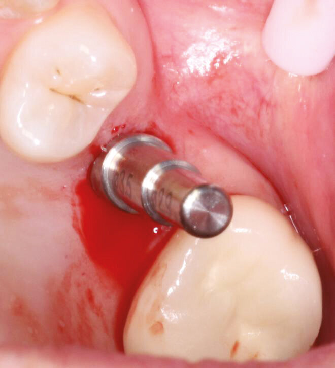 Fig.4: Parallel pin placed for verification. 