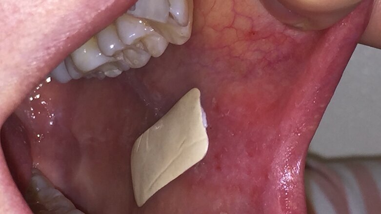 Interview: The Rivelin patch sticks to the mucosal surface for much longer than any other treatment