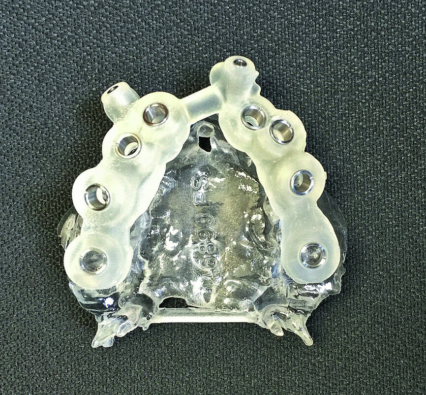 Fig. 7: Surgical guide for maxillary implants.