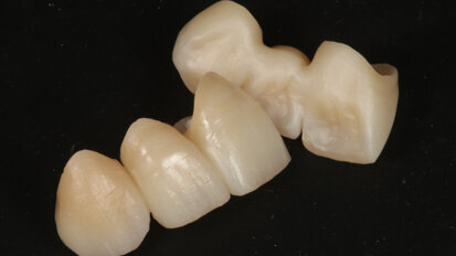 Fig. 11: Restorations after internal staining.