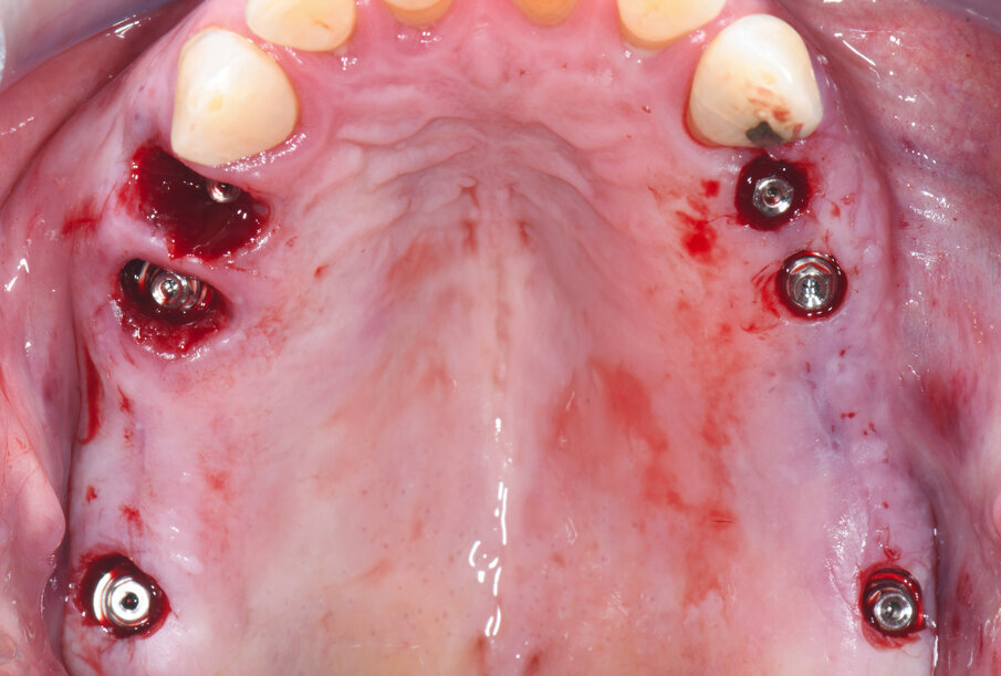 Obr. 3: Implantáty s bezprostředně umístěnými abutmenty MultiBase EV.
