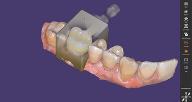 Exocad releases ChairsideCAD 3.0 Galway software for single-visit dentistry