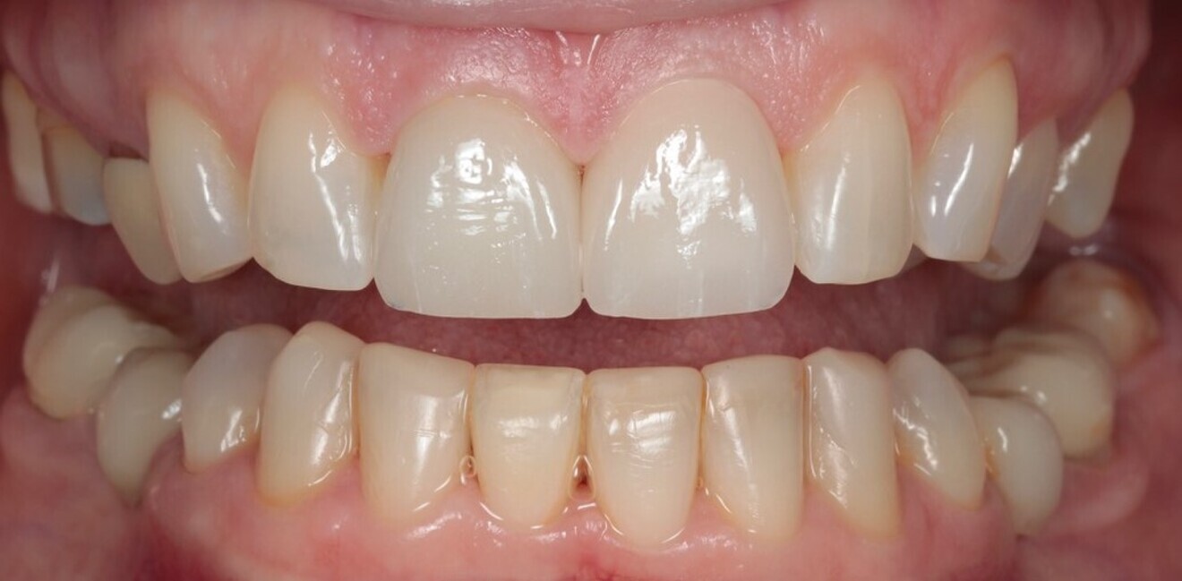 Fig. 14: 2021—the repaired mandibular central incisal edge still intact.