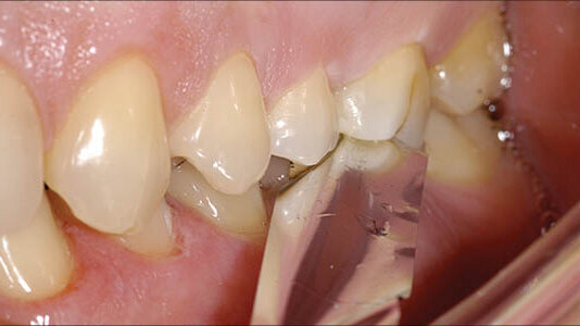 Artikulační papíry a tipy pro kontrolu okluze: klinické tipy pro vypořádání se s okluzními kontakty