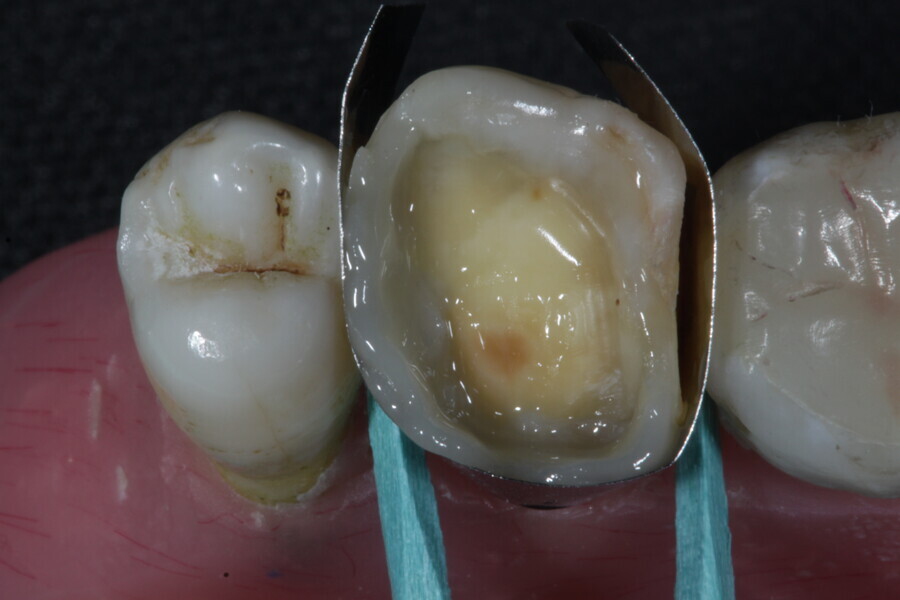 Fig. 37a: Missing walls are restored with a composite enamel layer (Estelite), converting the lesion to a Class I cavity.