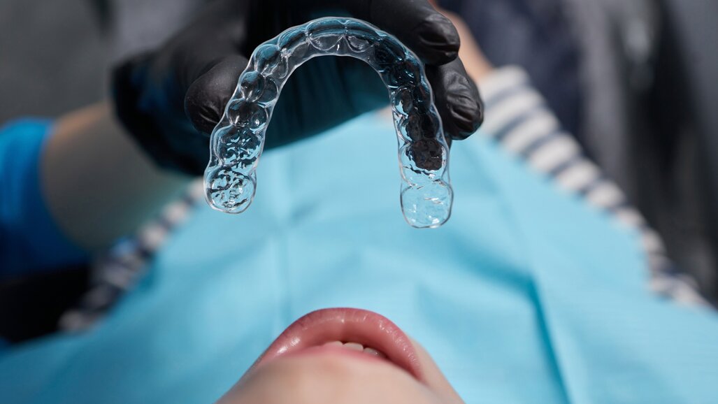 Interceptive aligner treatment in a growing Class&nbsp;II, Division&nbsp;1 patient

