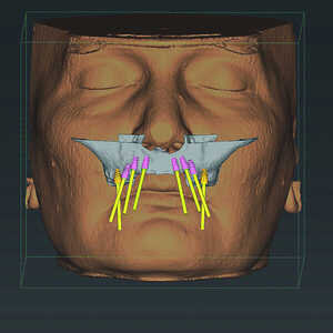 Fig-5-Analyse-dento-faciale-du-traitement-implantaire-proposé-dans-l’arcade-maxillaire-300x300-