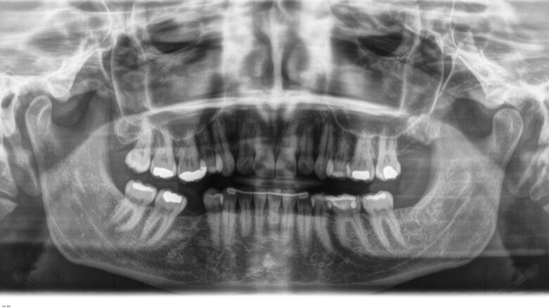 Intrusione molare con allineatori trasparenti per ottimizzare un trattamento implanto-protesico
