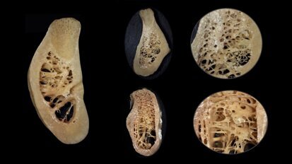 Piezocirugía  (3). La importancia de la biología ósea en la cirugía piezoeléctrica