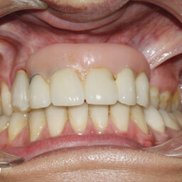 Opětovné implantologické ošetření