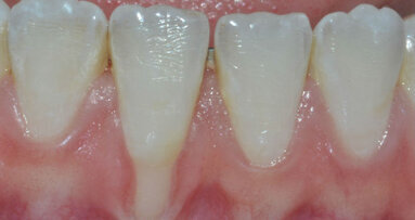 Chirurgia plastica parodontale opzioni terapeutiche nel trattamento estetico delle recessioni gengivali