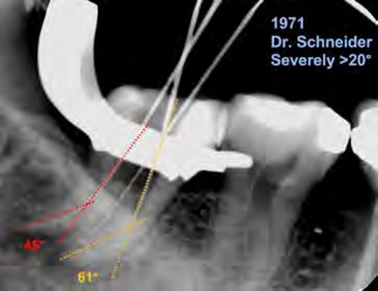 Fig. 1e: Radiographic assessment demonstrating severe canal curvatures  of the distal and mesiolingual canals measured according to Schneider’s method prior to canal preparation.